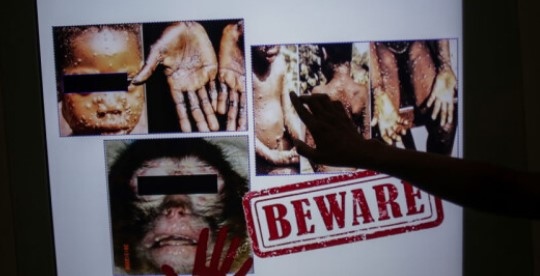 СЗО призова болните от маймунска шарка да избягват контакт с